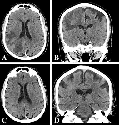 Corticosteroid-Induced Regression of Glioblastoma: A Radiographic Conundrum